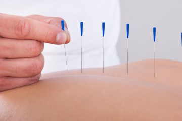 accupuncture